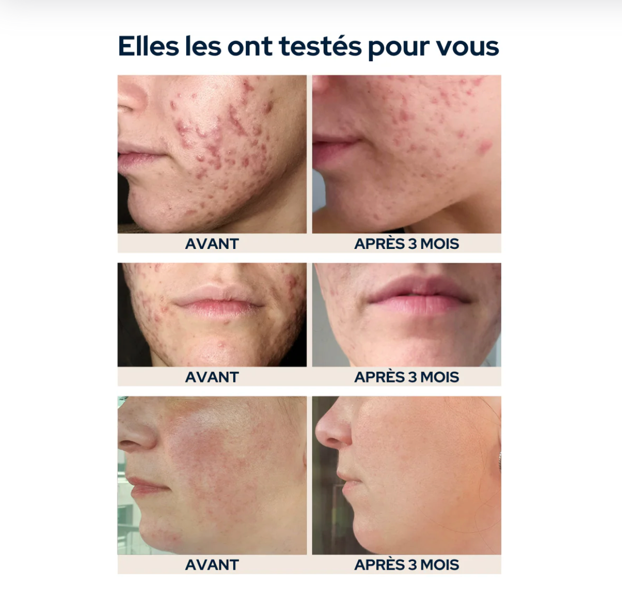 Gummies Anti-Imperfections – Epycure Laboratoire (60 gummies)