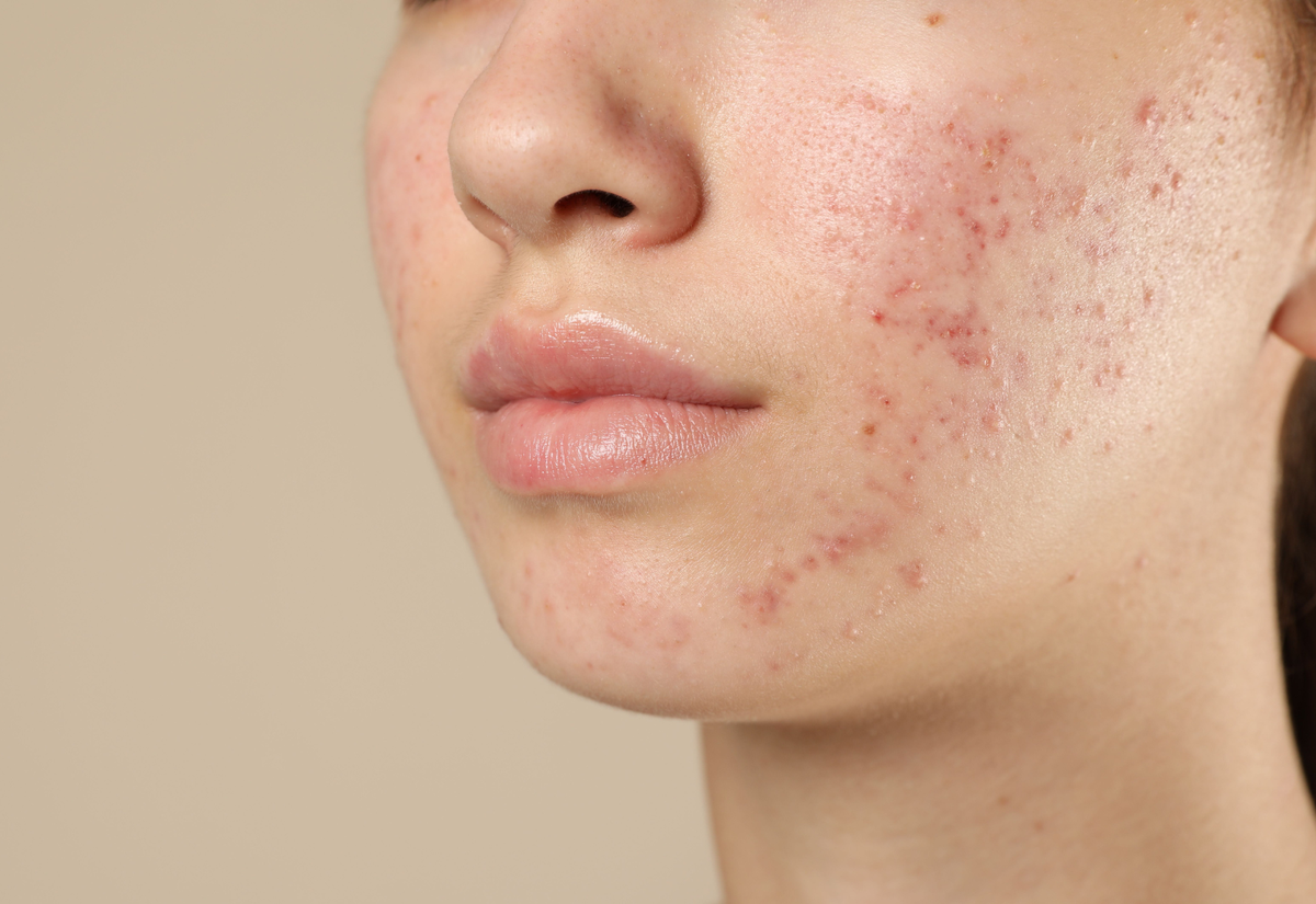 Acné & skincare : les ingrédients à éviter absolument